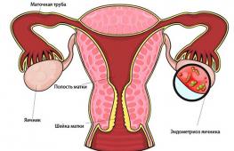 Эндометриоз и его влияние на способность зачать и выносить ребёнка Беременность после лечения эндометриоза силуэтом